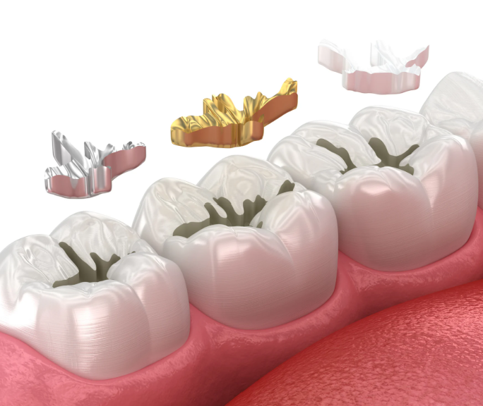 Dental filling Ipoh