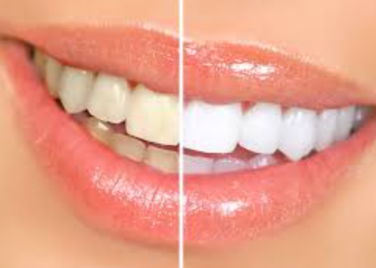 Teeth whitening Ipoh